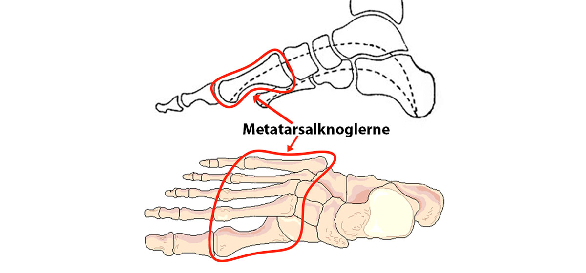 Visualisering af metatarsalknoglerne der påvirkes ved forfodsfald - Sahva