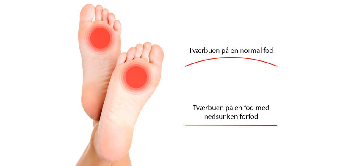 Nedsunken forfod sker af en sunken tværbue - Sahva