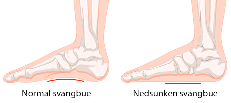 Forskellen på en "normal" og en nedsunken svangbue der kan resultere i smerter - Sahva