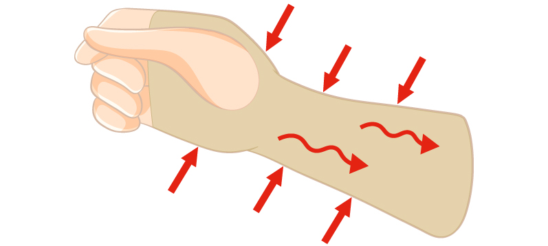 Kompressions afhjælper hævelse og smerter i arm og hænder - Sahva