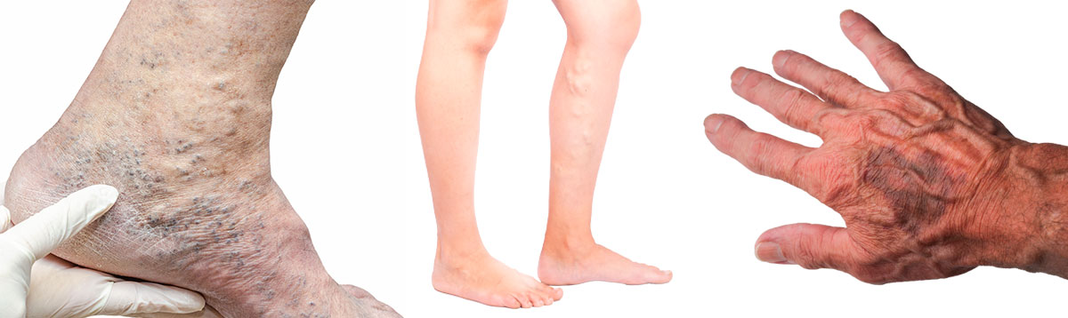 Brug kompression når du har åreknuder eller hævelser - Sahva