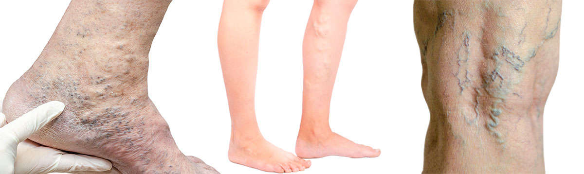 Kompressionsstrømper til dig med åreknuder og hævede ben - Sahva