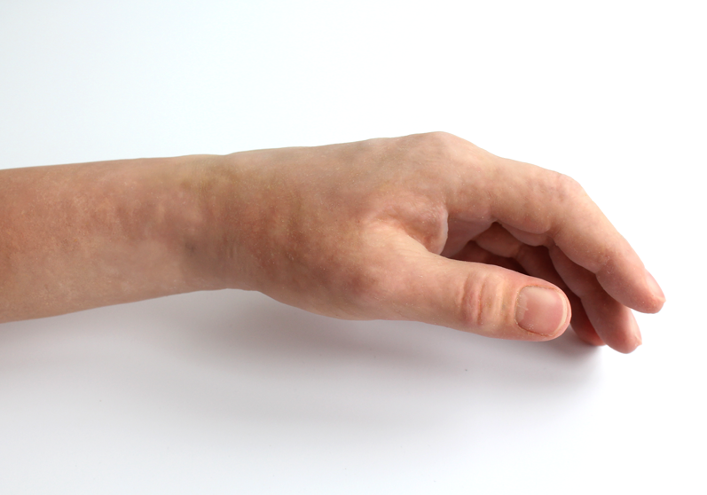 Æstetiske fingerproteser - Sahva