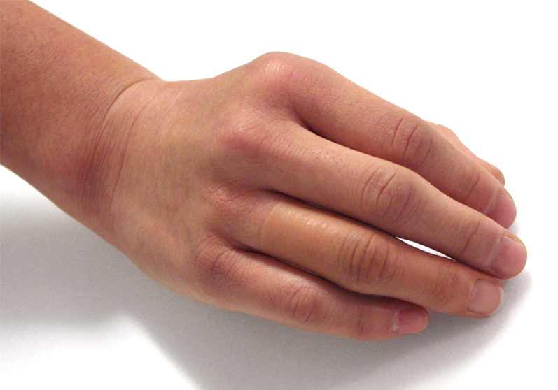 Hånd med fingerprotese - Sahva