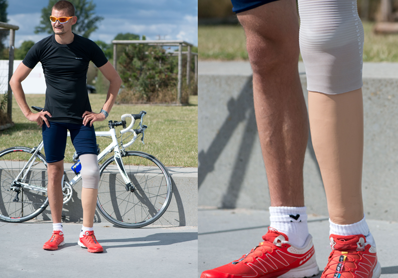 Underbensprotese på aktiv mand - Sahva