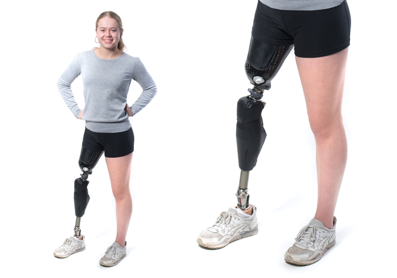 Pige med lårbensprotese - Sahva