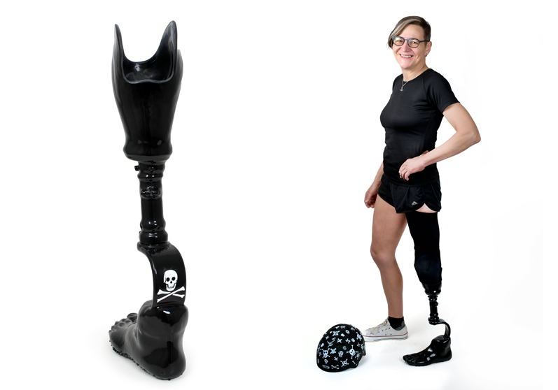 Lårbensprotese med individuelt design - Sahva