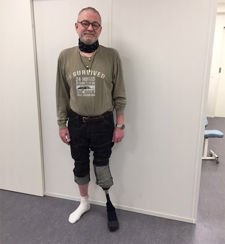 Benamputeret Torben passer på sit raske ben