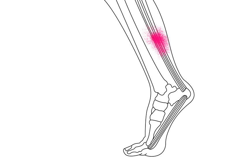 Illustration af achillessenen - Sahva