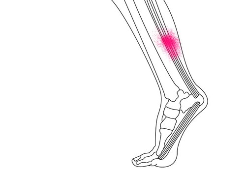 Illustration af achillessenen - Sahva