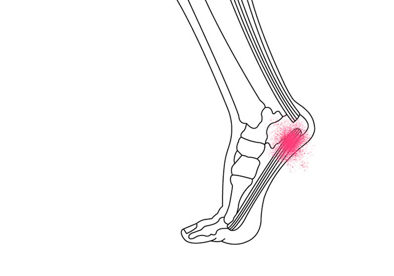 Har du hælsmerter? - Sahva