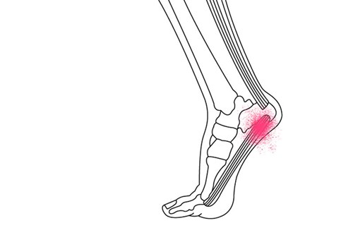 Smerter i hælen - Sahva