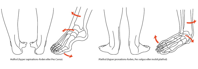 Illustration af hulfod og platfod - Sahva
