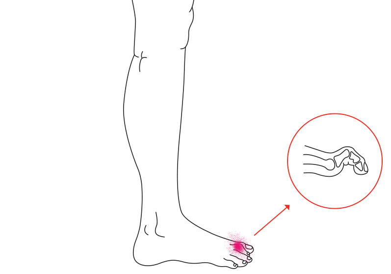 Illustration af hammertå - Sahva