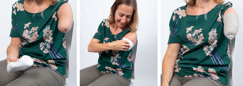 Kvinde tager sin armprotese liner på
