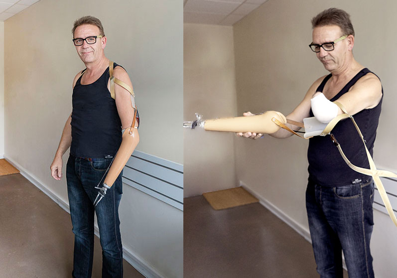 Mand med kabelstyret armprotese - Sahva