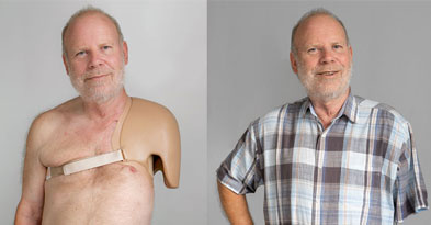 Overarmsproteser og skulderskjold - Sahva