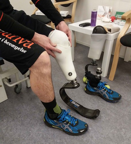 Benprotesebruger prøver 3D-printet løbeprotese