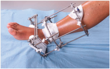 billede af et underben der er fikseret gennem et apperatur