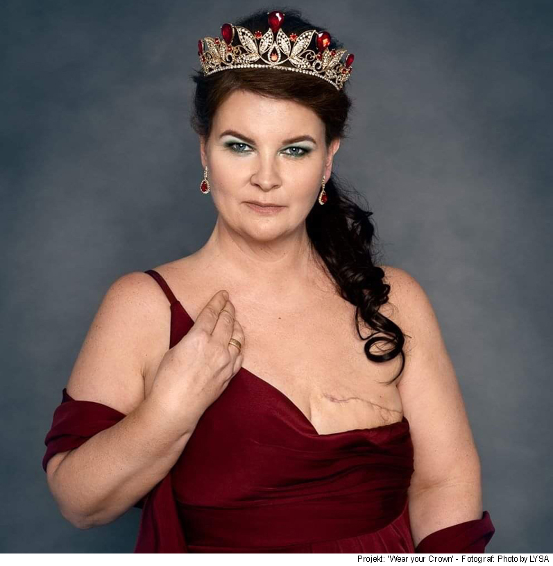 Brystamputeret kvinde viser sit ar efter operation - Sahva