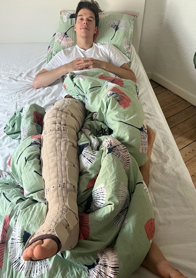 Sebastian i chok - ben hævede til dobbelt størrelse Sebastian i chok - ben hævede til dobbelt størrelse