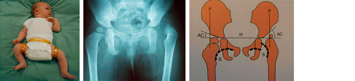 Hofteledsdysplasi - Sahva